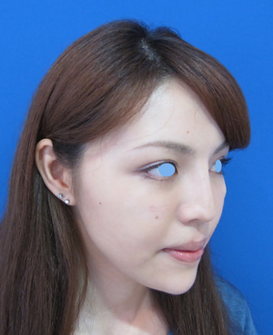 目の下のたるみ、目のくまでお悩みの方、切らずに完璧に解決します。TCB-R法　手術直後　症例写真